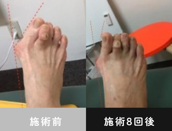 患者さま名:K様 女性 外反母趾タイプ 靭帯性外反母趾